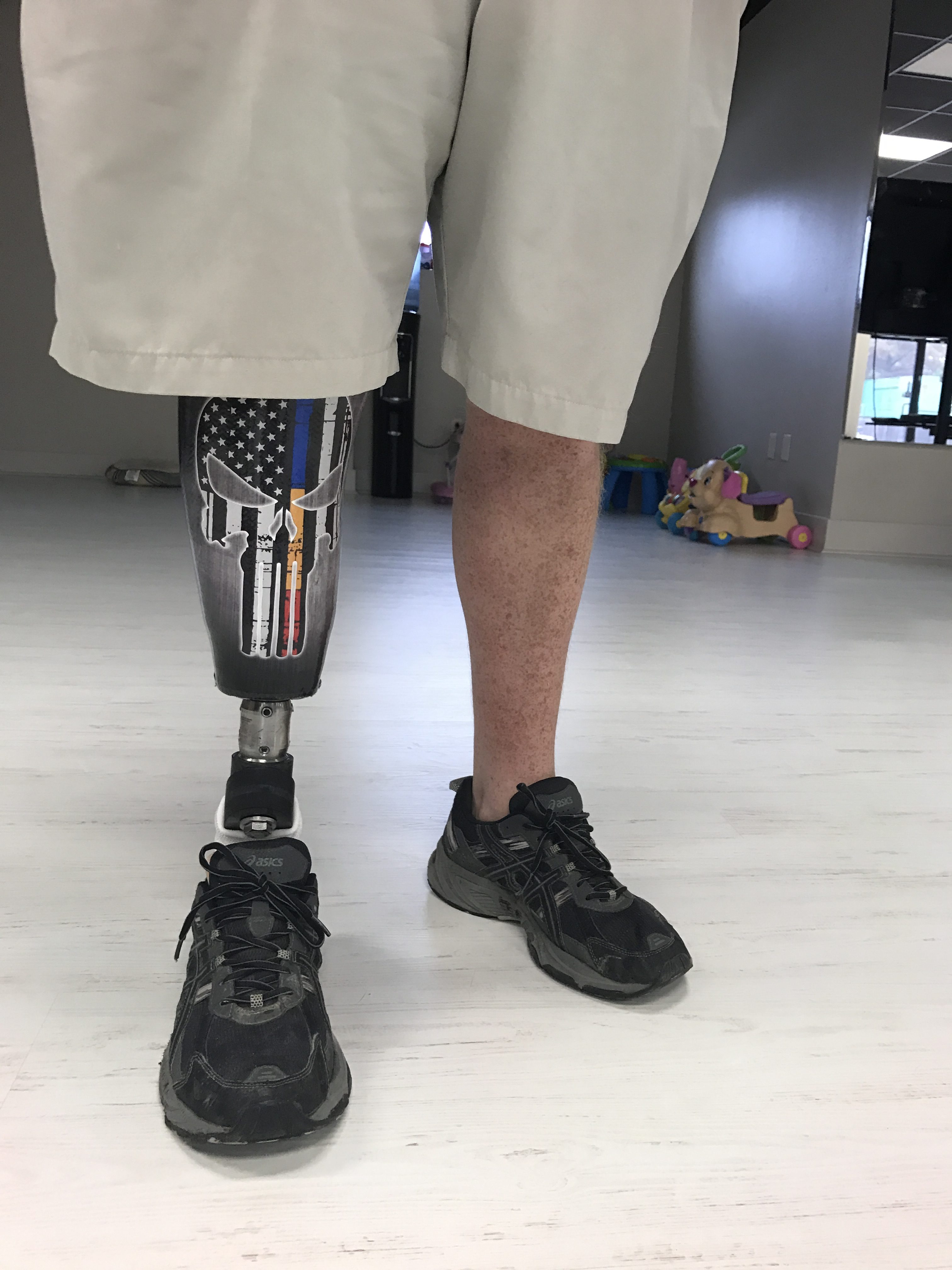 Above The Knee Prosthetic Legs: How To Take Your Silicone Liner with Pin  System Prosthesis On And Off - Walkabout Orthotics & Prosthetics